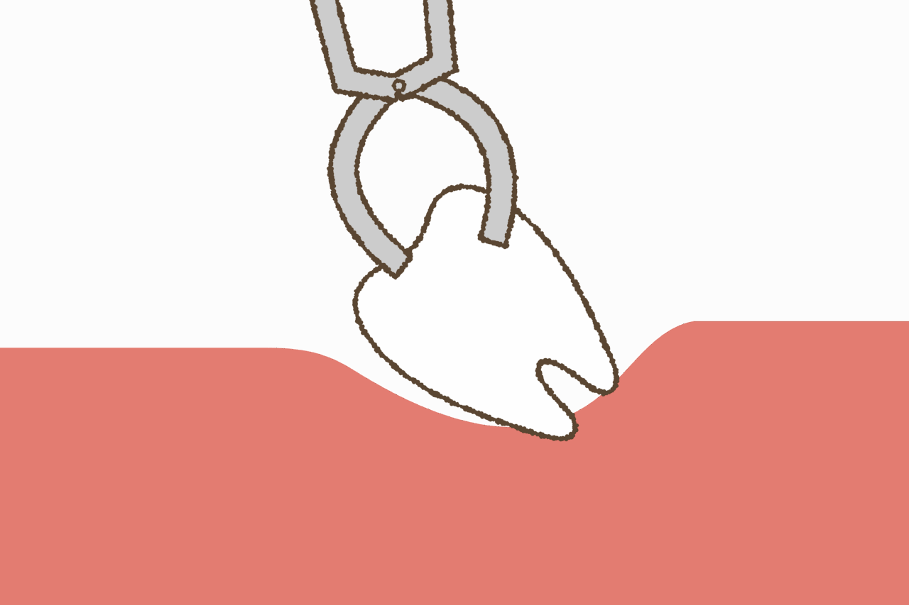 親知らずの抜歯後にやってはいけないことはある？