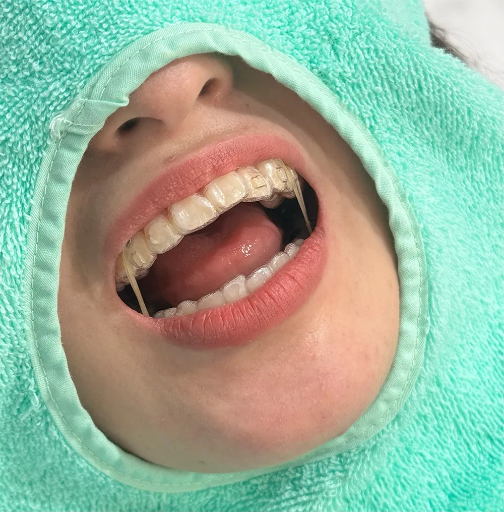 顎間ゴムを使用したときのイメージ