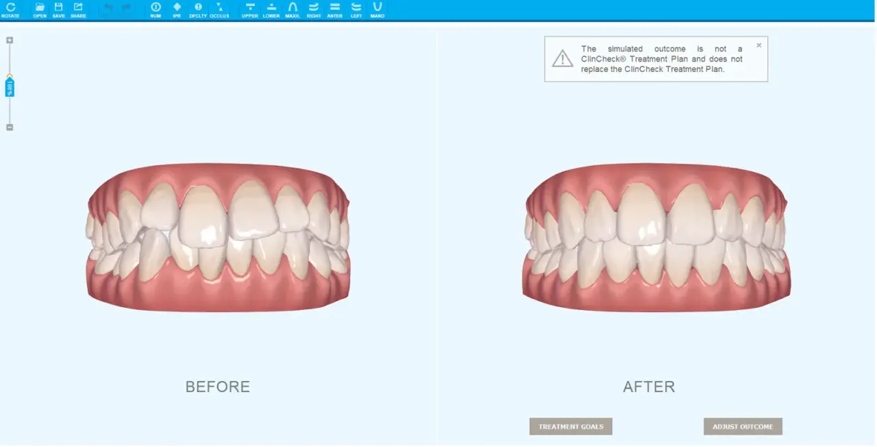 インビザラインの3D治療計画ソフト「クリンチェック」の画面