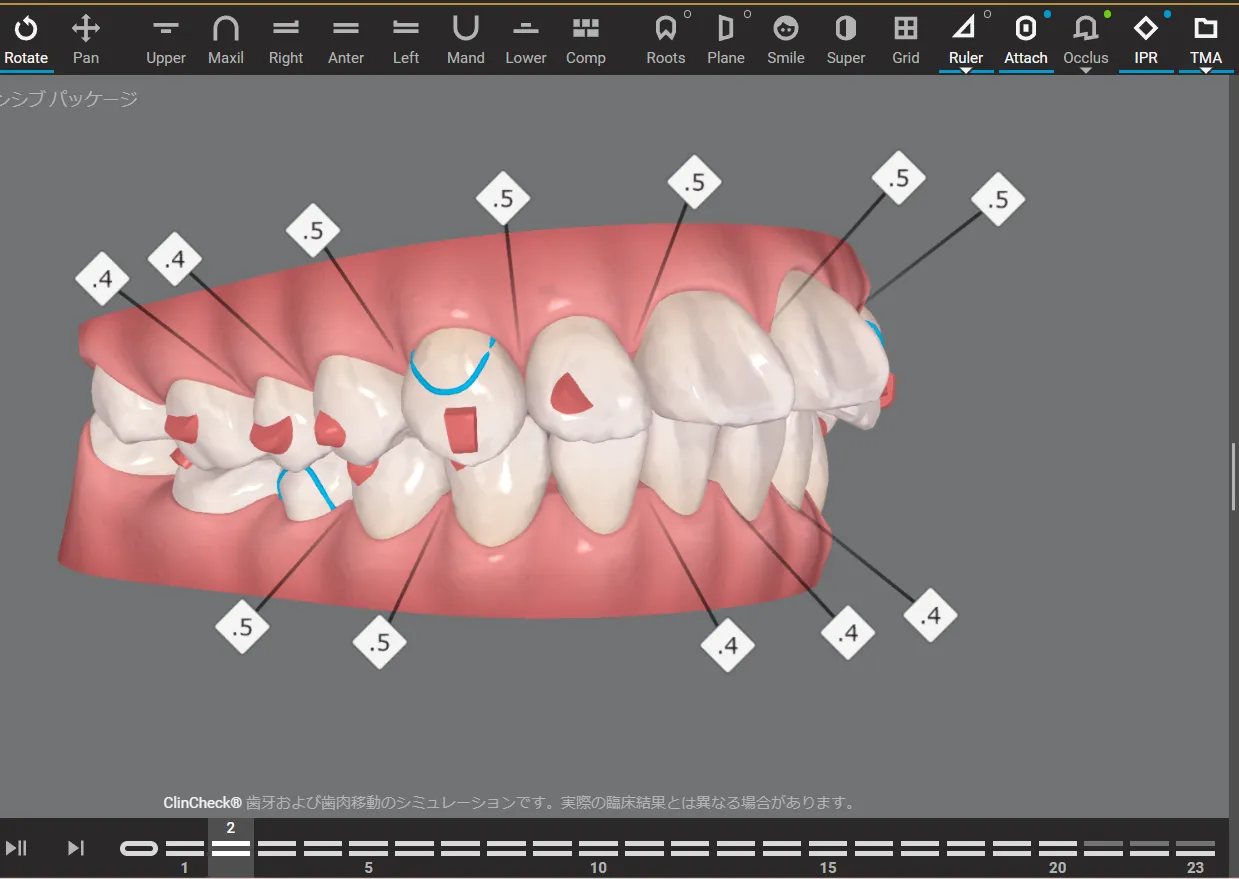 マウスピース矯正インビザラインの精密なシミュレーション画像